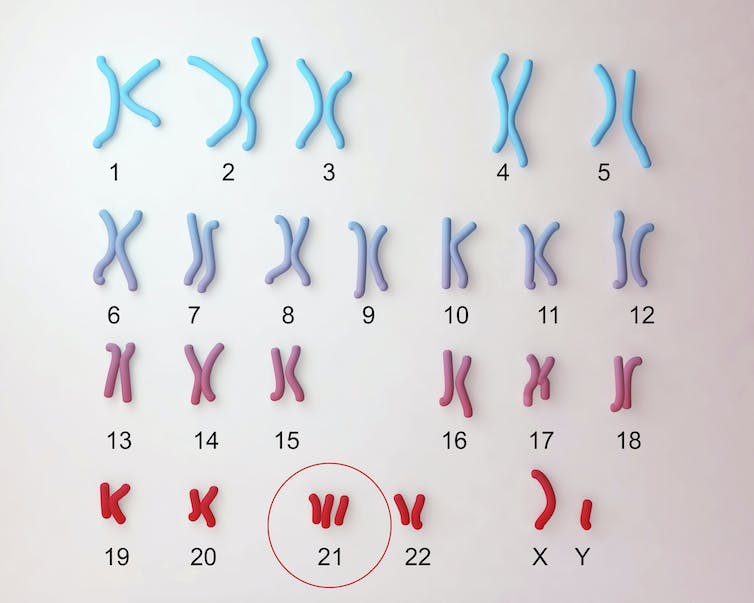 Down syndrome karyotype, with a circle around three copies of chromosome 21